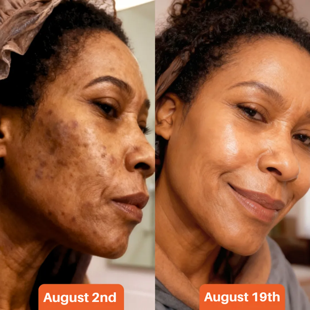 Anti-Acne & Dark Spots African Soap